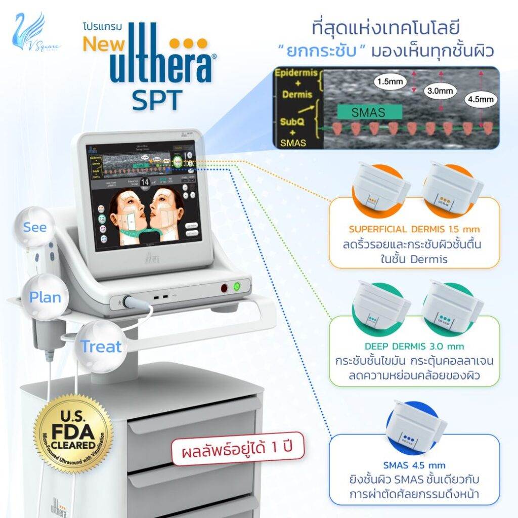 เครื่องUlthera SPT