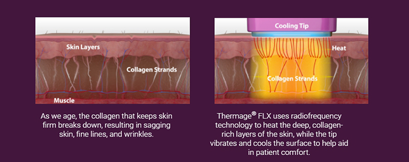 การทำงานของ Thermage