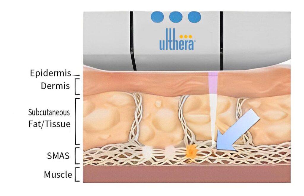 หลักการทำงานเครื่อง Ulthera