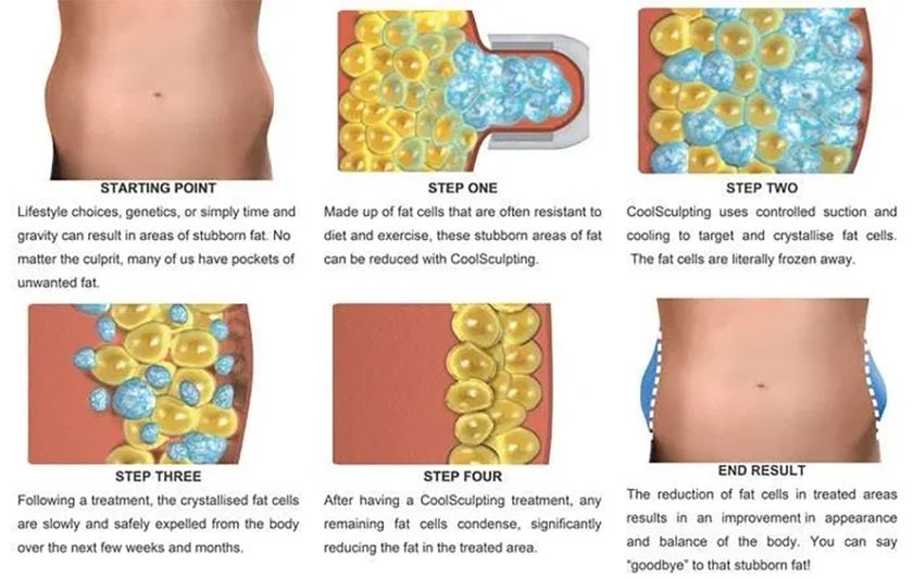 หลักการทำงานของ CoolSculpting